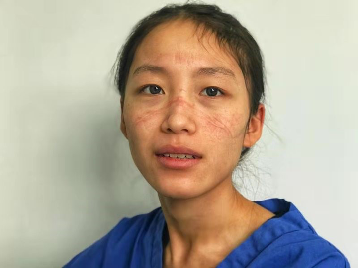 Nos últimos dois dias, uma foto de Chen Ying, uma enfermeira nascida na geração pós 95, viralizou na internet devido às cicatrizes profundas de usar máscara e óculos por muito tempo